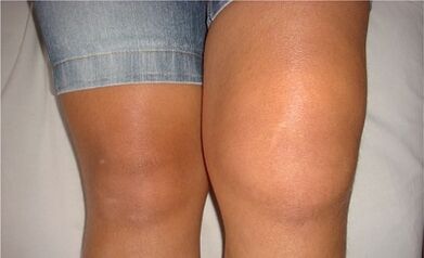 The causes of arthrosis of the knee joint