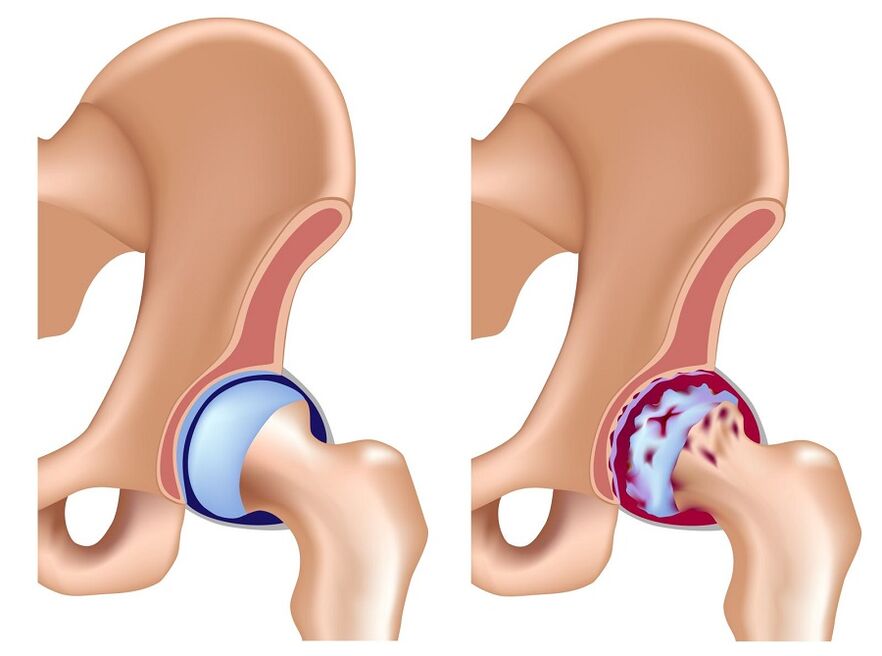 healthy joint and arthrosis of the hip joint