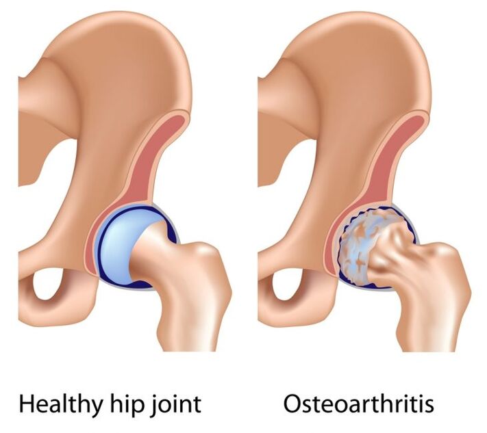 healthy joint and arthrosis of the hip joint